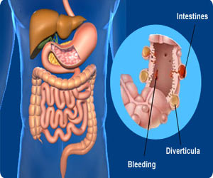 symptoms of diverticulosis